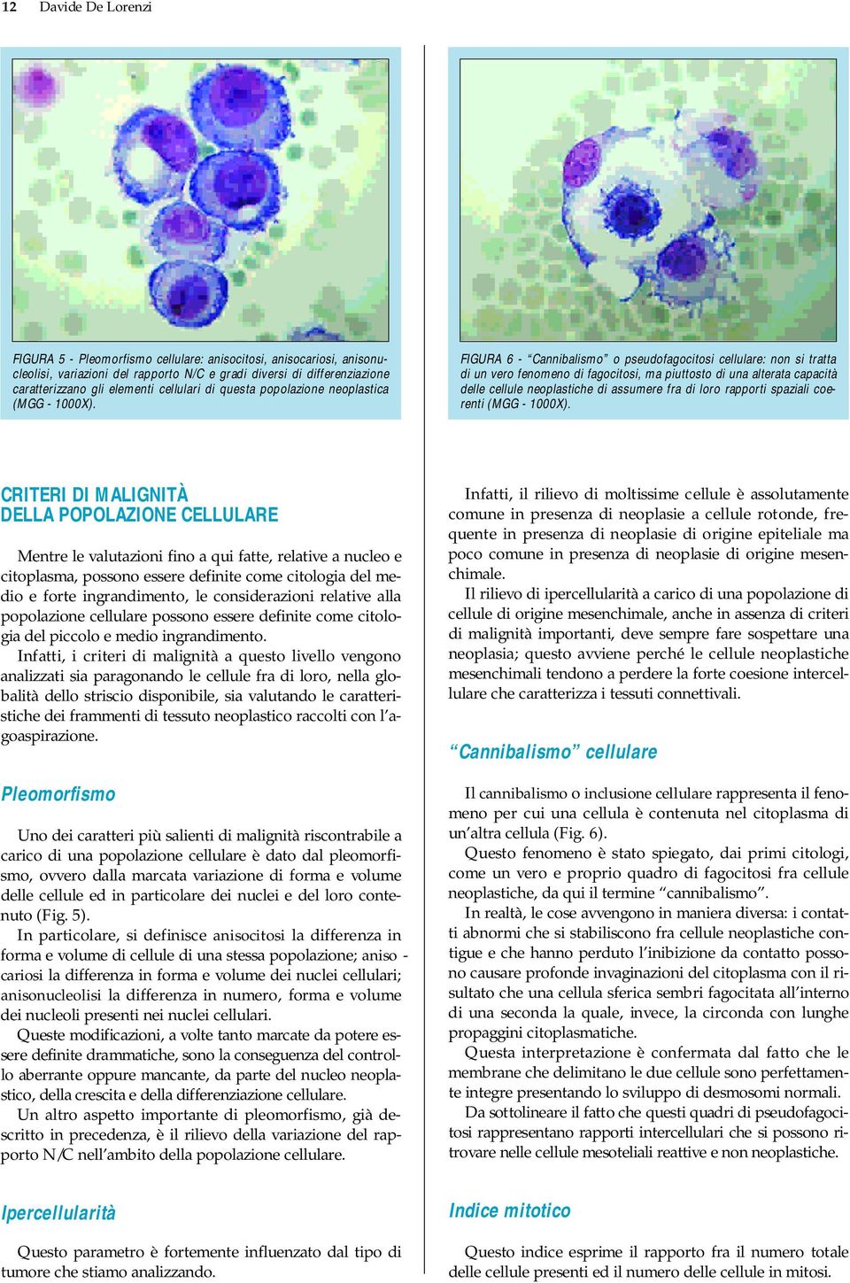 FIGURA 6 - Cannibalismo o pseudofagocitosi cellulare: non si tratta di un vero fenomeno di fagocitosi, ma piuttosto di una alterata capacità delle cellule neoplastiche di assumere fra di loro