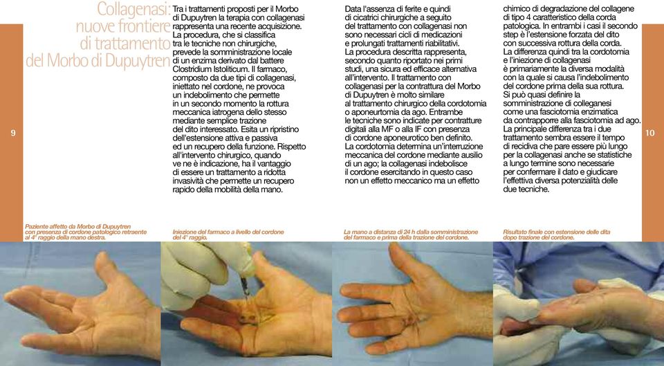 In entrambi i casi il secondo La procedura, che si classifica sono necessari cicli di medicazioni step è l estensione forzata del dito di trattamento tra le tecniche non chirurgiche, e prolungati