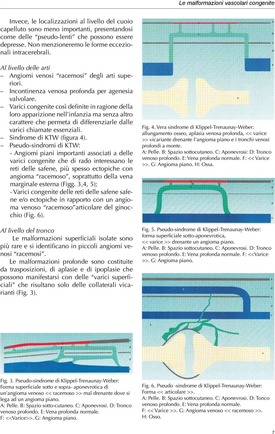 Varici congenite così definite in ragione della loro apparizione nell infanzia ma senza altro carattere che permeta di differenziarle dalle varici chiamate essenziali. Sindrome di KTW (figura 4).