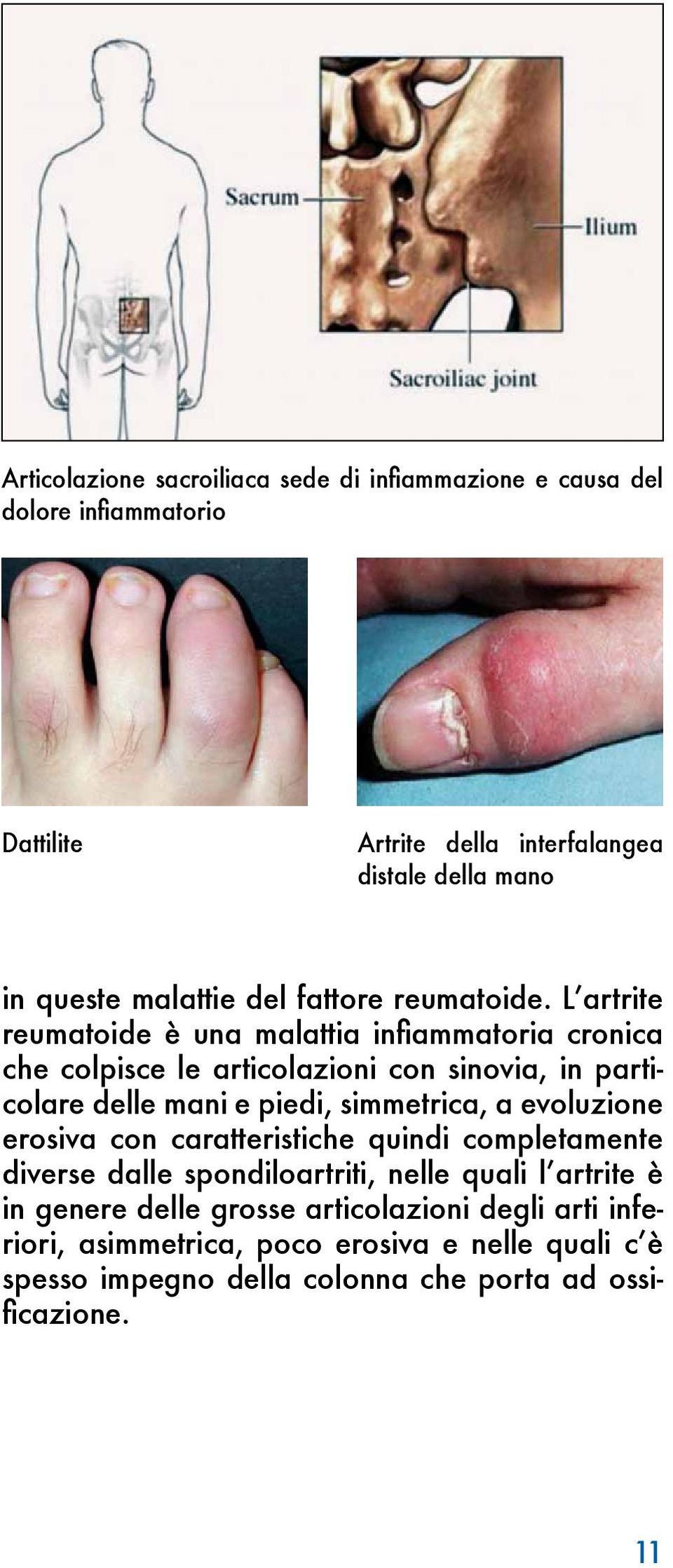 L artrite reumatoide è una malattia infiammatoria cronica che colpisce le articolazioni con sinovia, in particolare delle mani e piedi, simmetrica, a