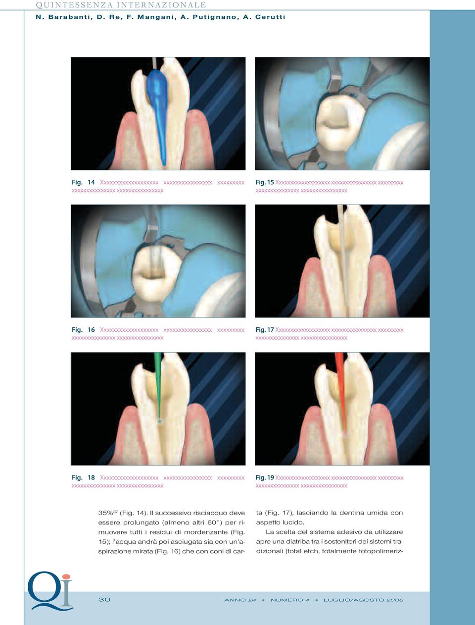 15); l acqua andrà poi asciugata sia con un aspirazione mirata (Fig. 16) che con coni di carta (Fig. 17), lasciando la dentina umida con aspetto lucido.