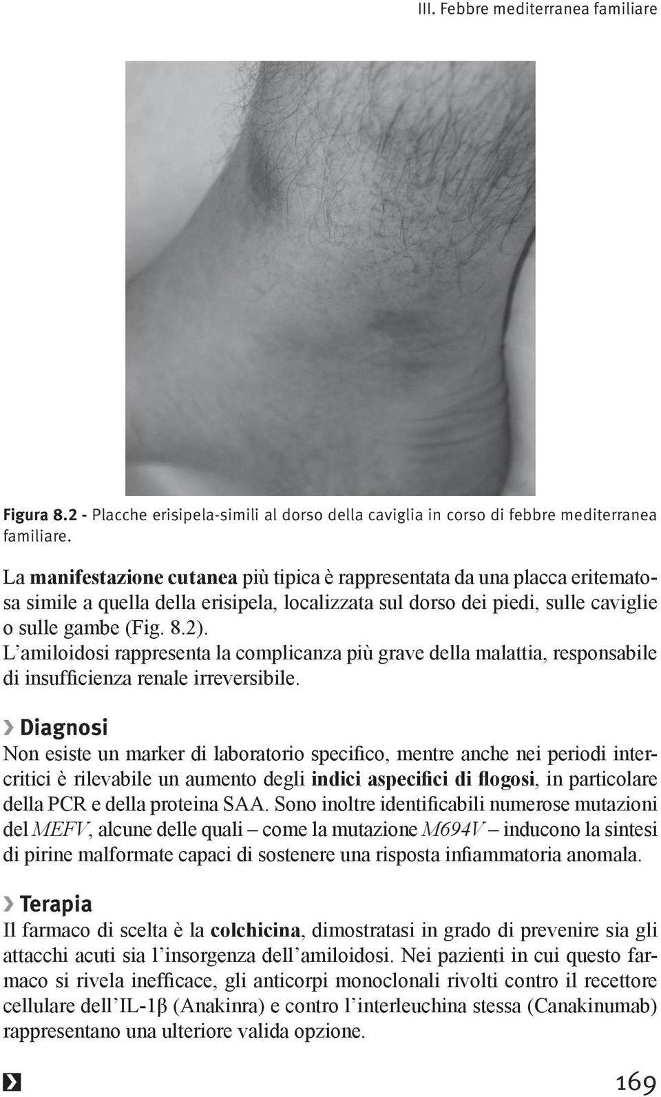 L amiloidosi rappresenta la complicanza più grave della malattia, responsabile Diagnosi critici è rilevabile un aumento degli, in particolare del MEFV, alcune delle quali come la mutazione