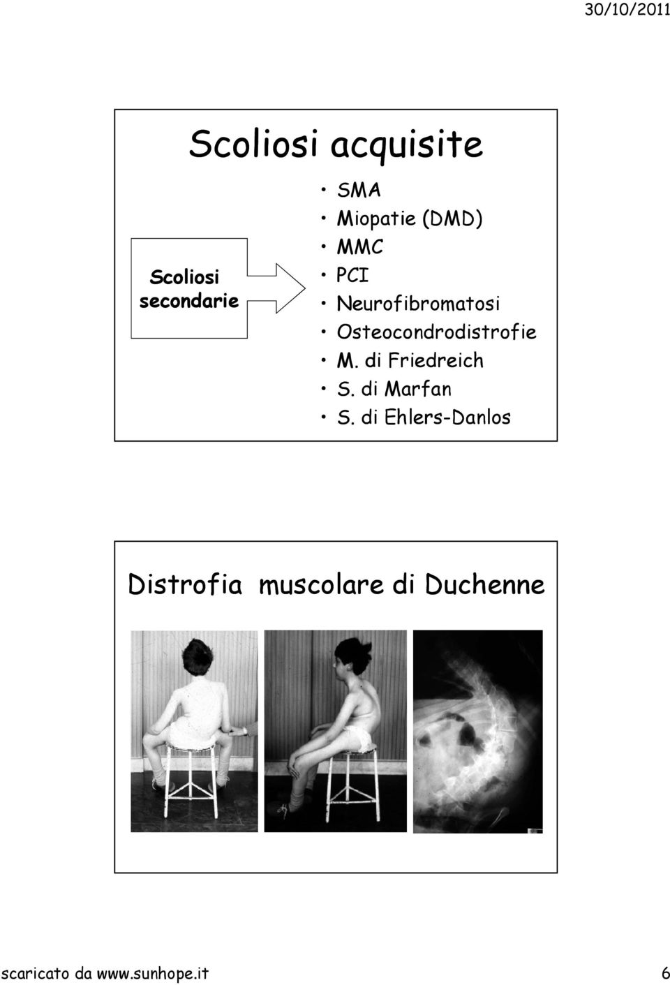 di Friedreich S. di Marfan S.