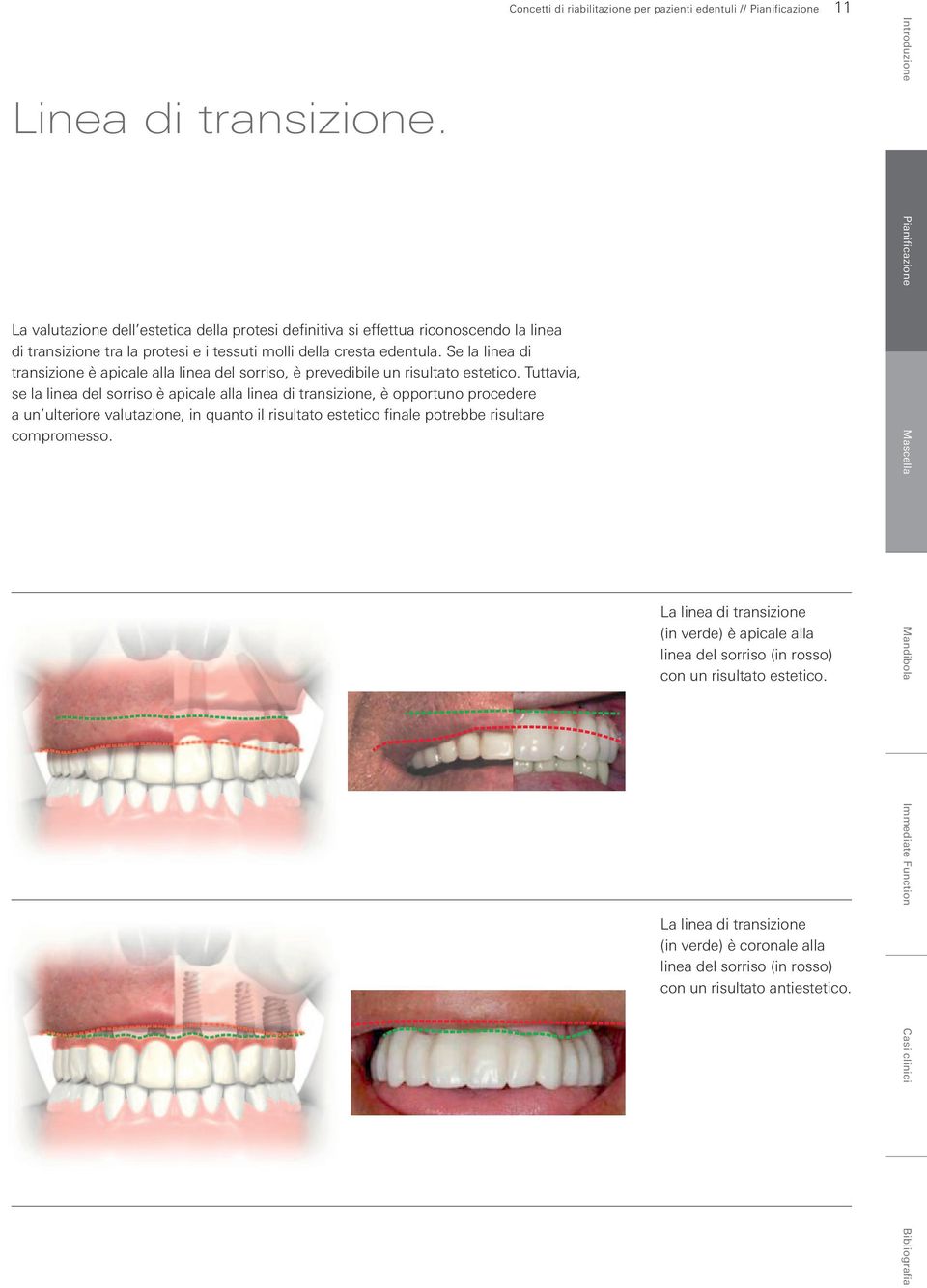 tessuti molli della cresta edentula. Se la linea di transizione è apicale alla linea del sorriso, è prevedibile un risultato estetico.