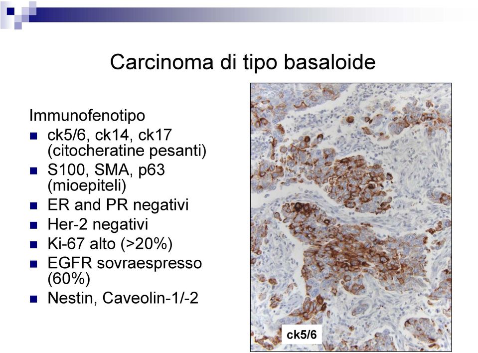 (mioepiteli) ER and PR negativi Her-2 negativi Ki-67