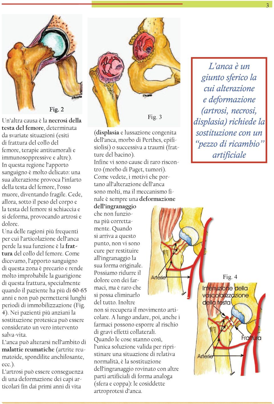 Cede, allora, sotto il peso del corpo e la testa del femore si schiaccia e si deforma, provocando artrosi e dolore.