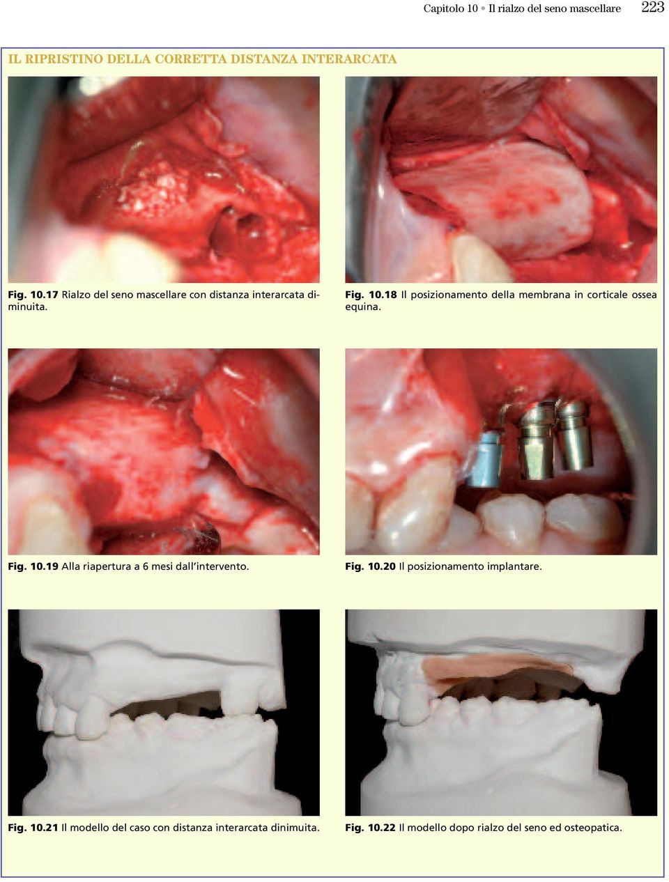 Fig. 10.20 Il posizionamento implantare. Fig. 10.21 Il modello del caso con distanza interarcata dinimuita. Fig. 10.22 Il modello dopo rialzo del seno ed osteopatica.