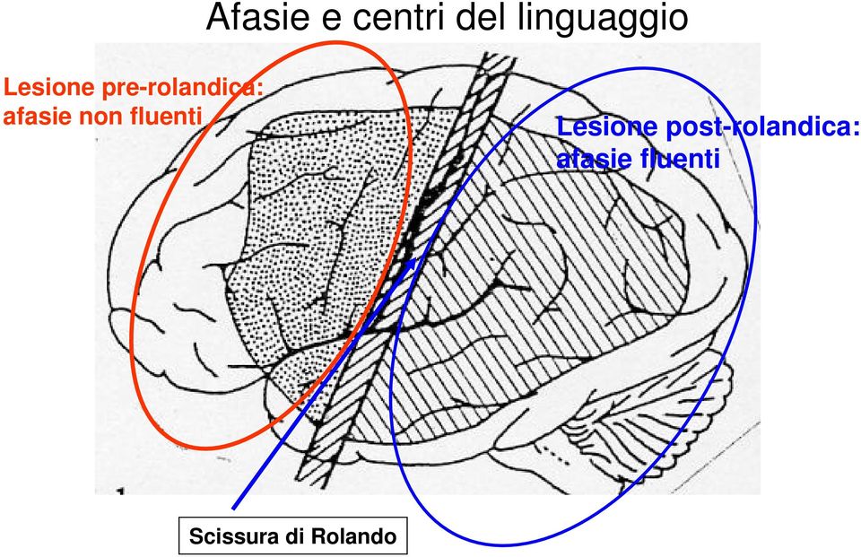 non fluenti Lesione