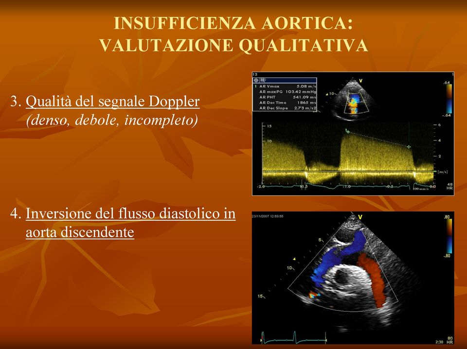 Qualità del segnale Doppler (denso,