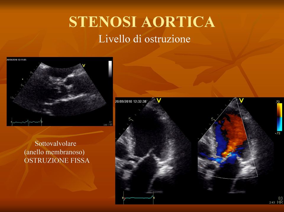 FISSA STENOSI AORTICA