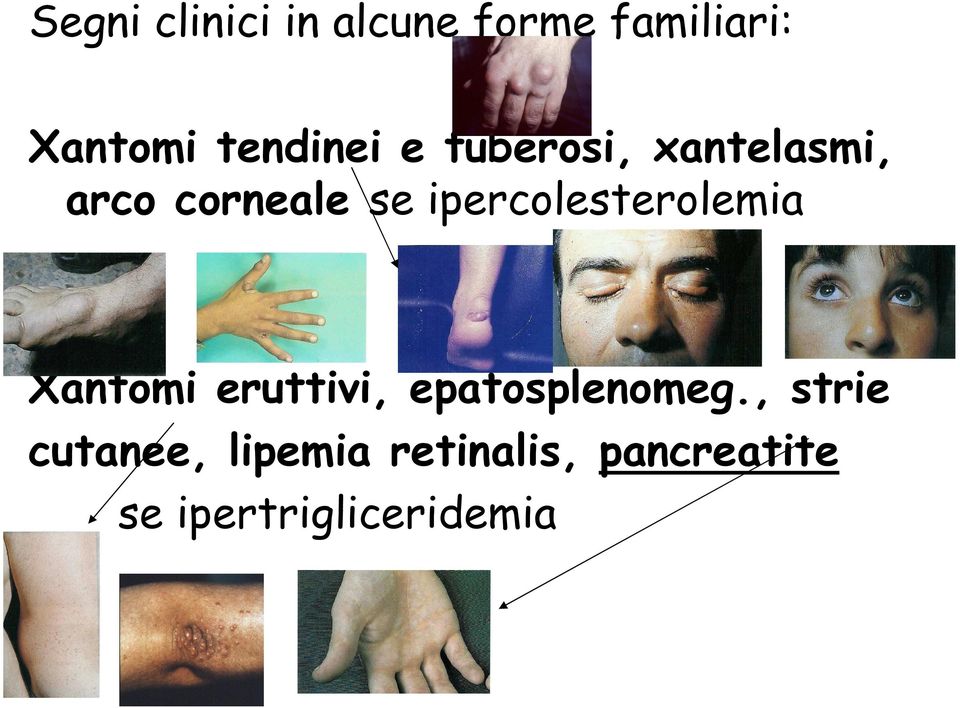 ipercolesterolemia Xantomi eruttivi, epatosplenomeg.