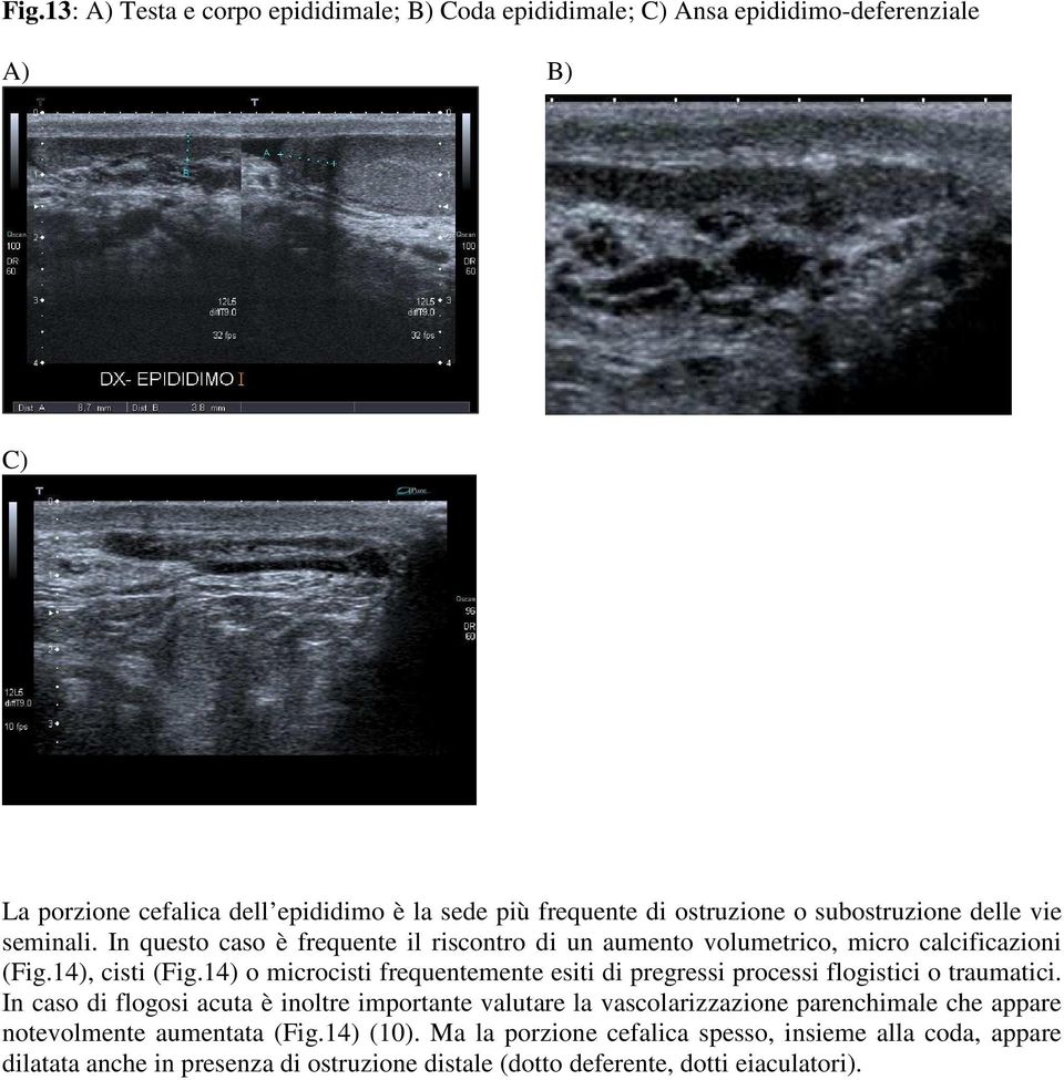 14) o microcisti frequentemente esiti di pregressi processi flogistici o traumatici.