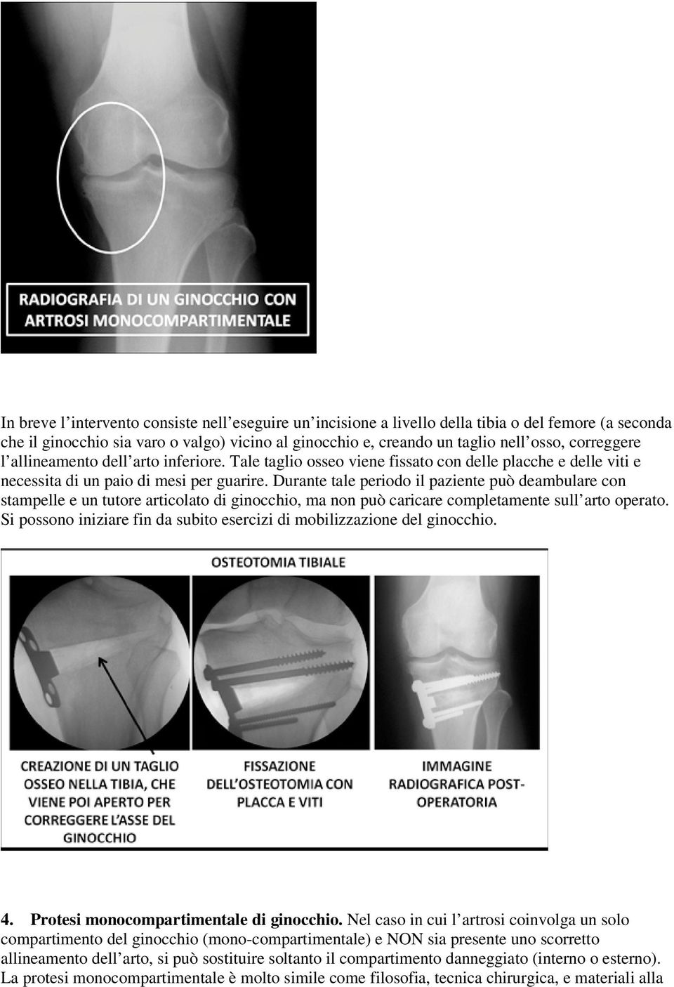 Durante tale periodo il paziente può deambulare con stampelle e un tutore articolato di ginocchio, ma non può caricare completamente sull arto operato.