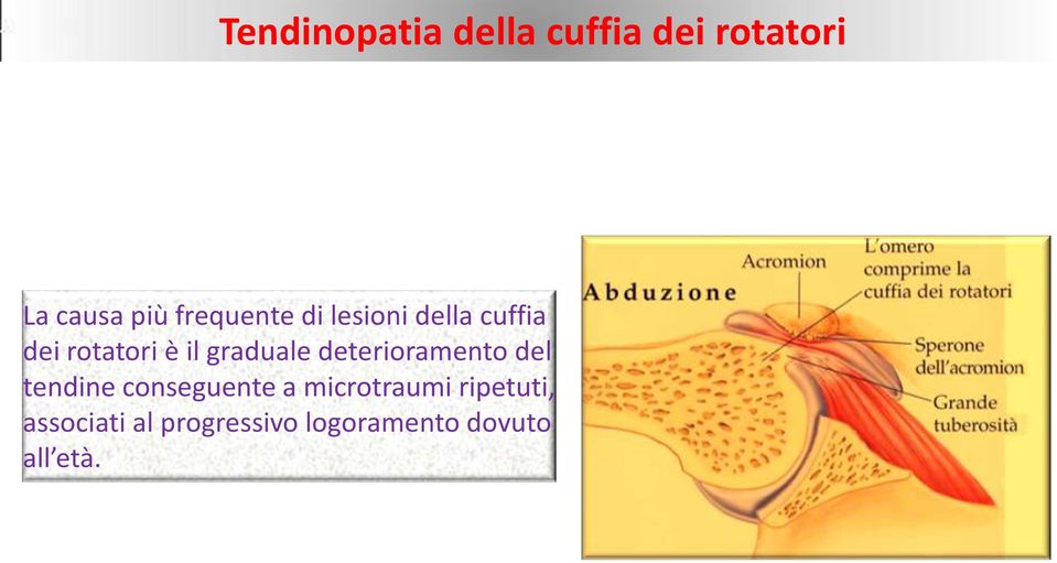 graduale deterioramento del tendine conseguente a