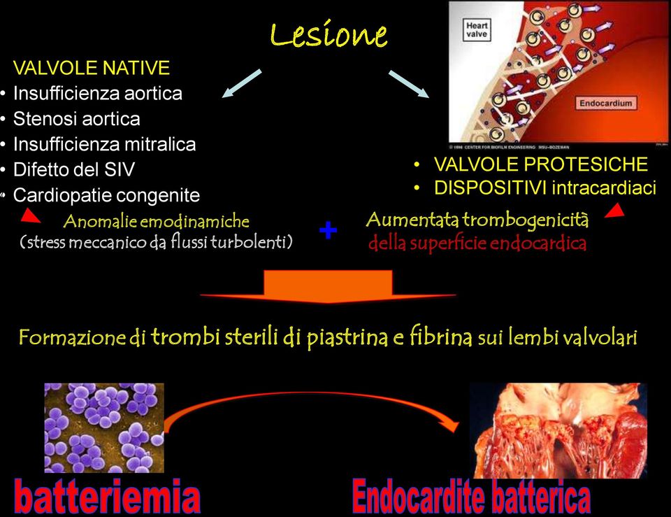 turbolenti) + VALVOLE PROTESICHE DISPOSITIVI intracardiaci Aumentata trombogenicità della