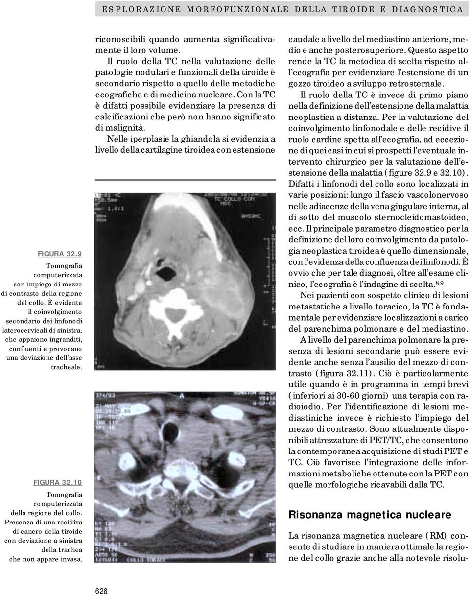 10 Tomografia computerizzata della regione del collo. Presenza di una recidiva di cancro della tiroide con deviazione a sinistra della trachea che non appare invasa.