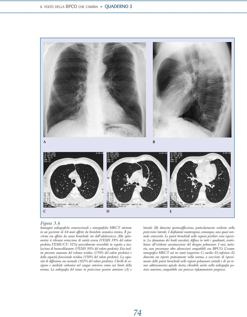 Alla spirometria si rilevava ostruzione di entità severa (VEMS 39% del valore predetto,vems/cv 32%) parzialmente reversibile in seguito a inalazione di broncodilatatore (VEMS 50% del valore predetto).