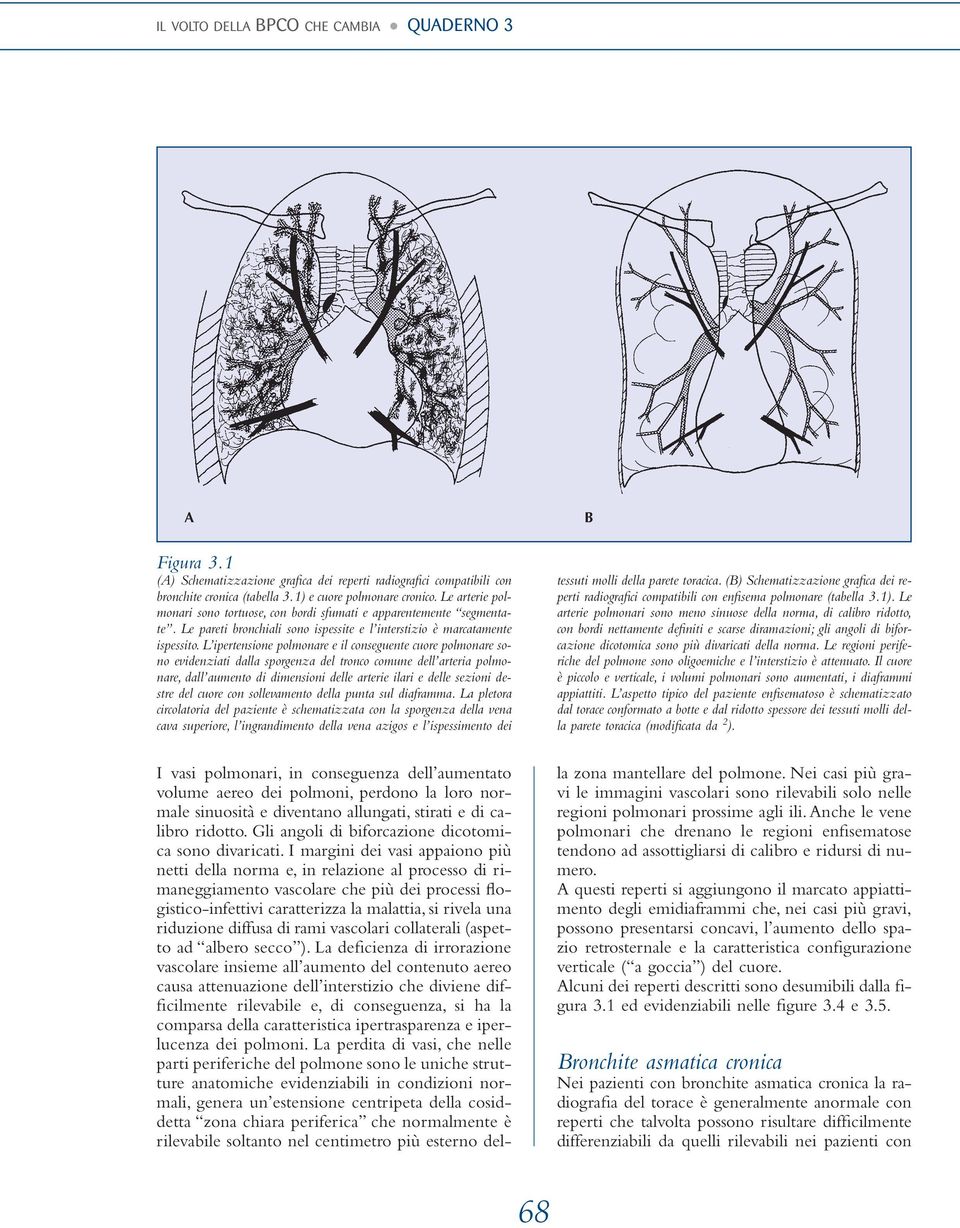 L ipertensione polmonare e il conseguente cuore polmonare sono evidenziati dalla sporgenza del tronco comune dell arteria polmonare, dall aumento di dimensioni delle arterie ilari e delle sezioni