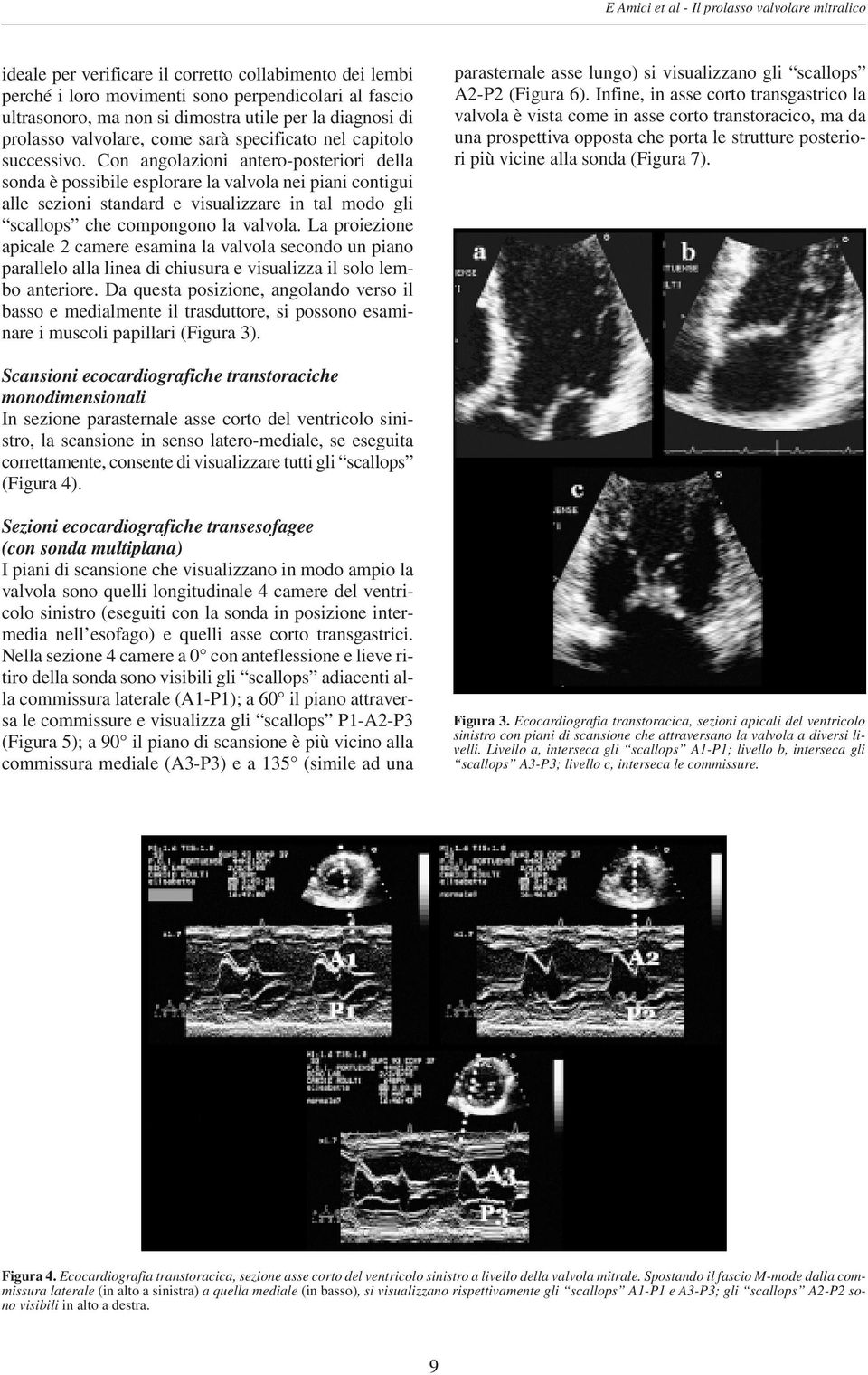 Con angolazioni antero-posteriori della sonda è possibile esplorare la valvola nei piani contigui alle sezioni standard e visualizzare in tal modo gli scallops che compongono la valvola.