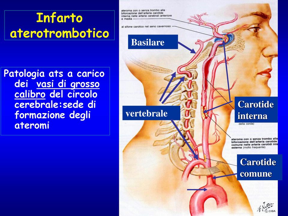 circolo cerebrale:sede di formazione degli