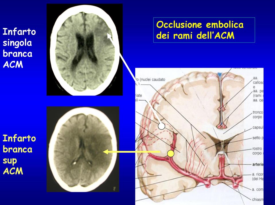 embolica dei rami