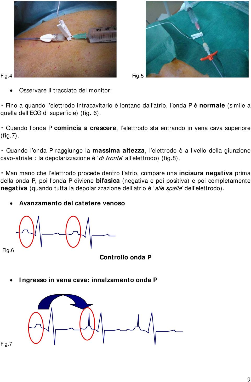 Quando l onda P raggiunge la massima altezza, l elettrodo è a livello della giunzione cavo-atriale : la depolarizzazione è di fronte all elettrodo) (fig.8).