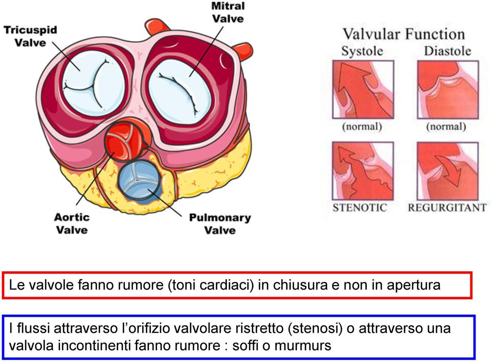 orifizio valvolare ristretto (stenosi) o