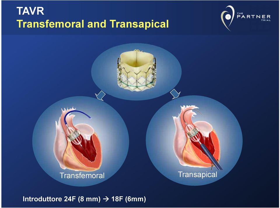 Transfemoral 