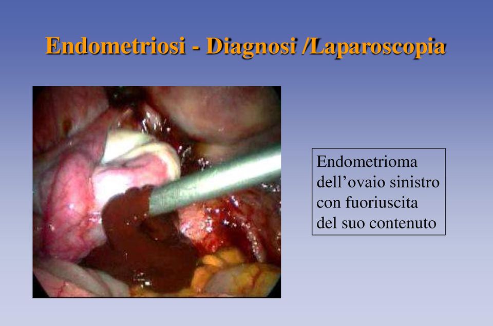 Endometrioma dell ovaio