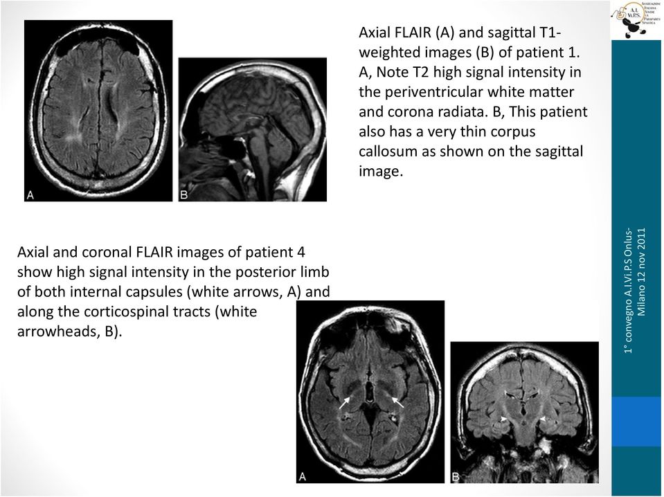 B, This patient also has a very thin corpus callosum as shown on the sagittal image.