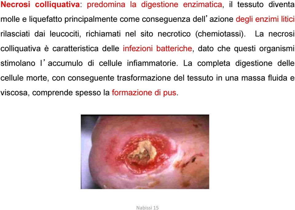 La necrosi colliquativa è caratteristica delle infezioni batteriche, dato che questi organismi stimolano l accumulo di cellule