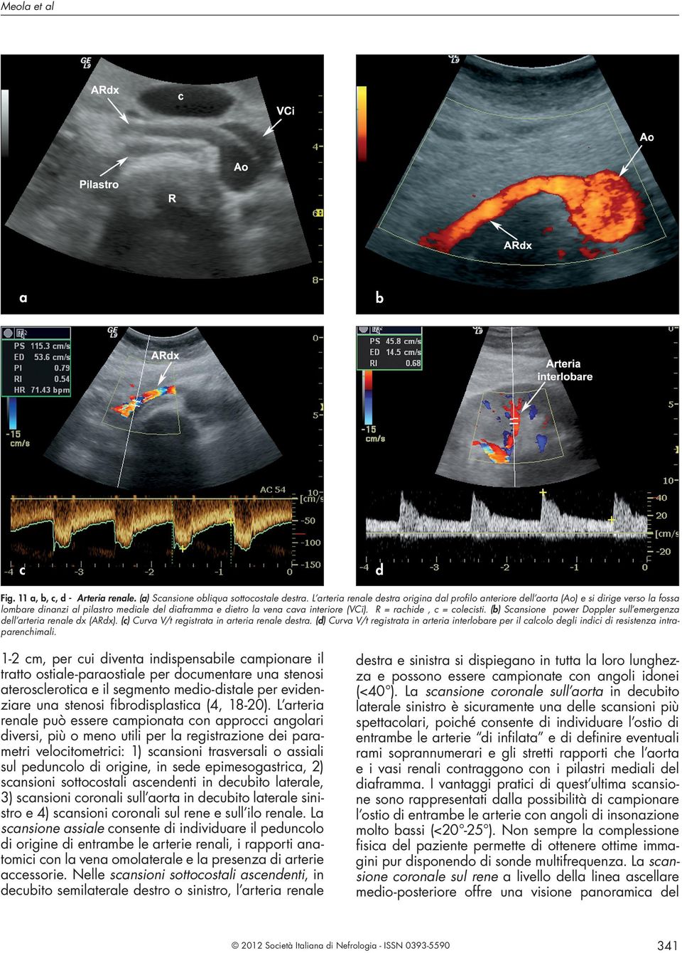 R = rachide, c = colecisti. (b) Scansione power Doppler sull emergenza dell arteria renale dx (ARdx). (c) Curva V/t registrata in arteria renale destra.