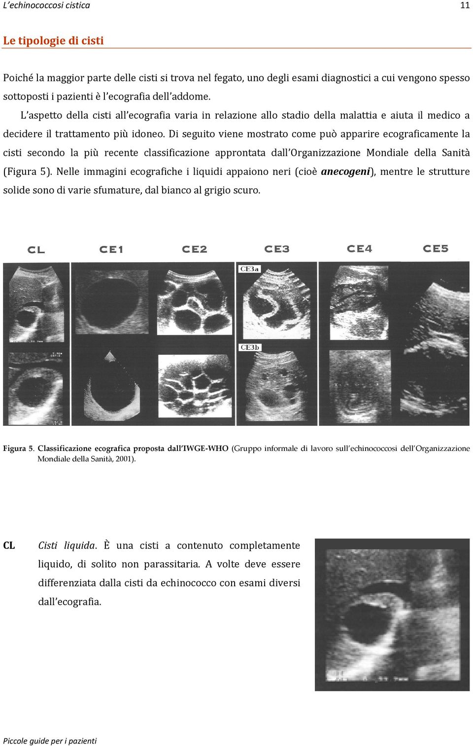 Di seguito viene mostrato come può apparire ecograficamente la cisti secondo la più recente classificazione approntata dall Organizzazione Mondiale della Sanità (Figura 5).