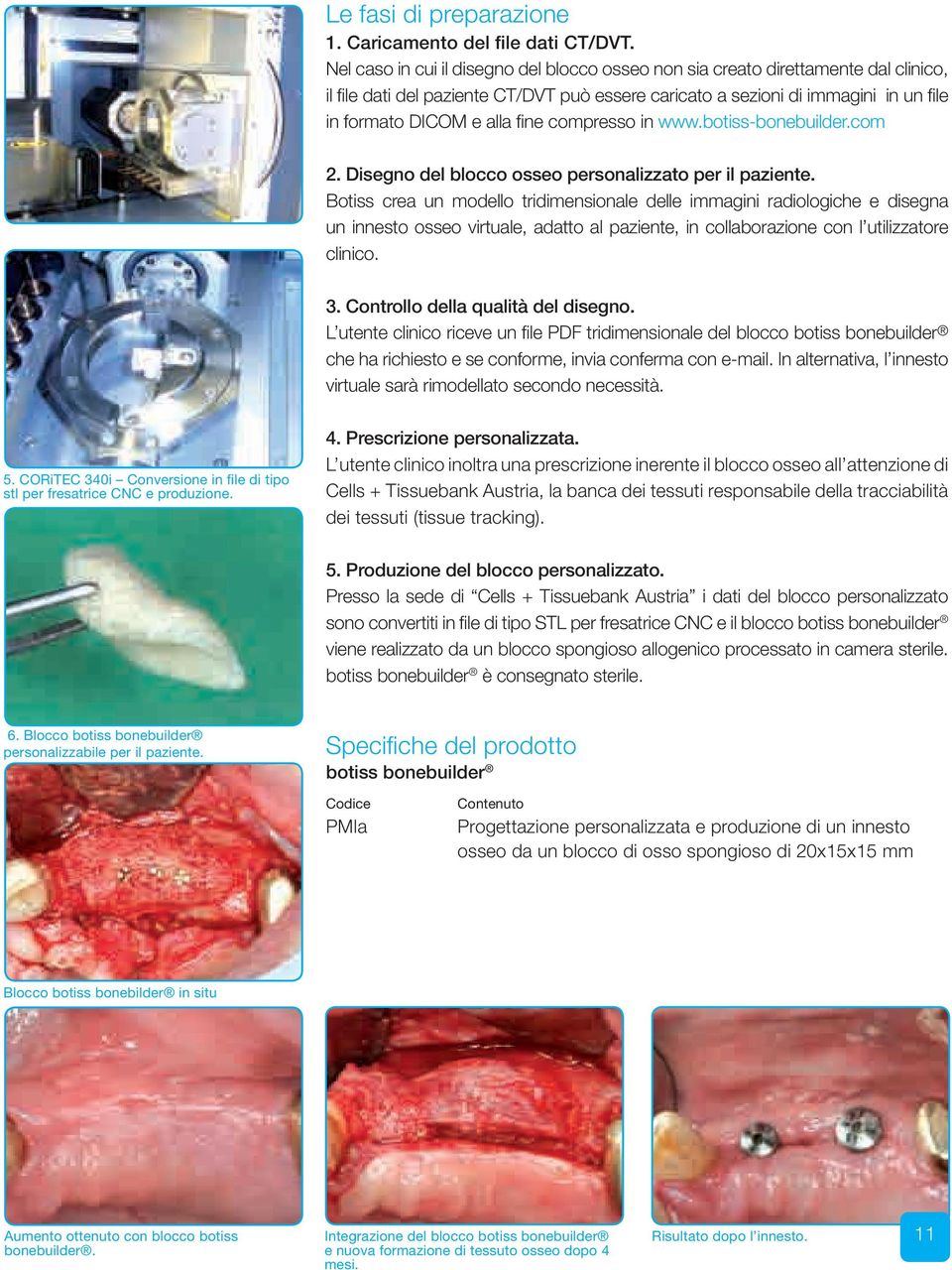 compresso in www.botiss-bonebuilder.com 2. Disegno del blocco osseo personalizzato per il paziente.