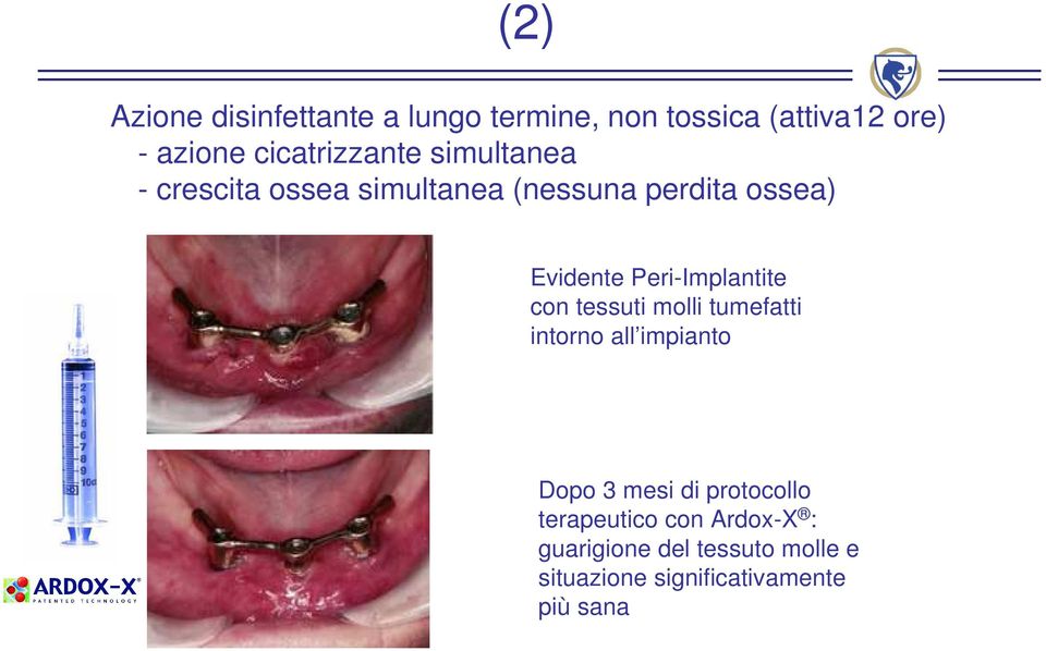 Peri-Implantite con tessuti molli tumefatti intorno all impianto Dopo 3 mesi di