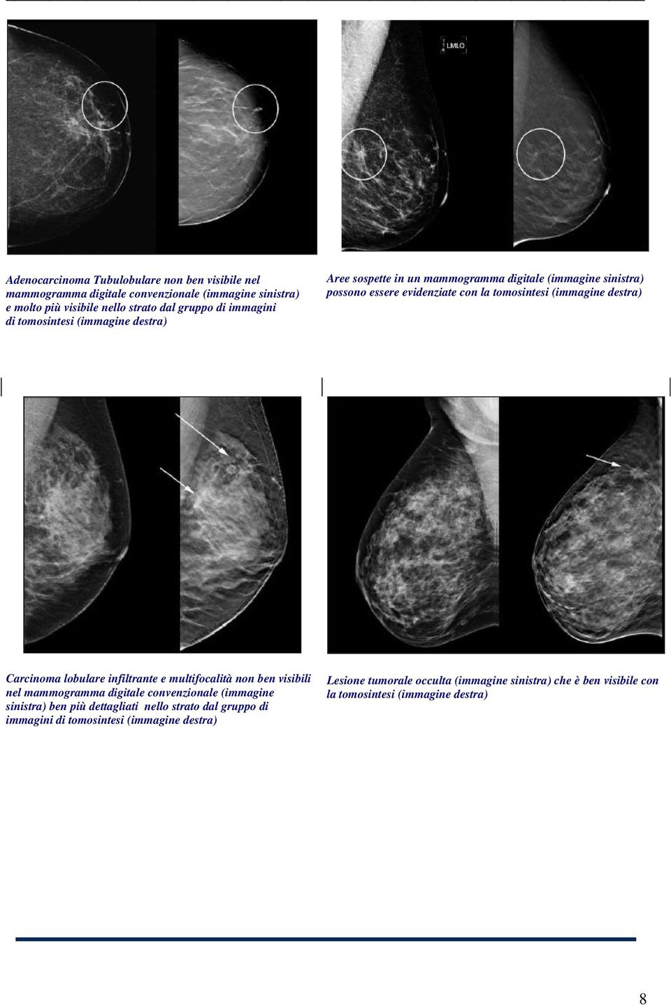 destra) Carcinoma lobulare infiltrante e multifocalità non ben visibili nel mammogramma digitale convenzionale (immagine sinistra) ben più dettagliati nello