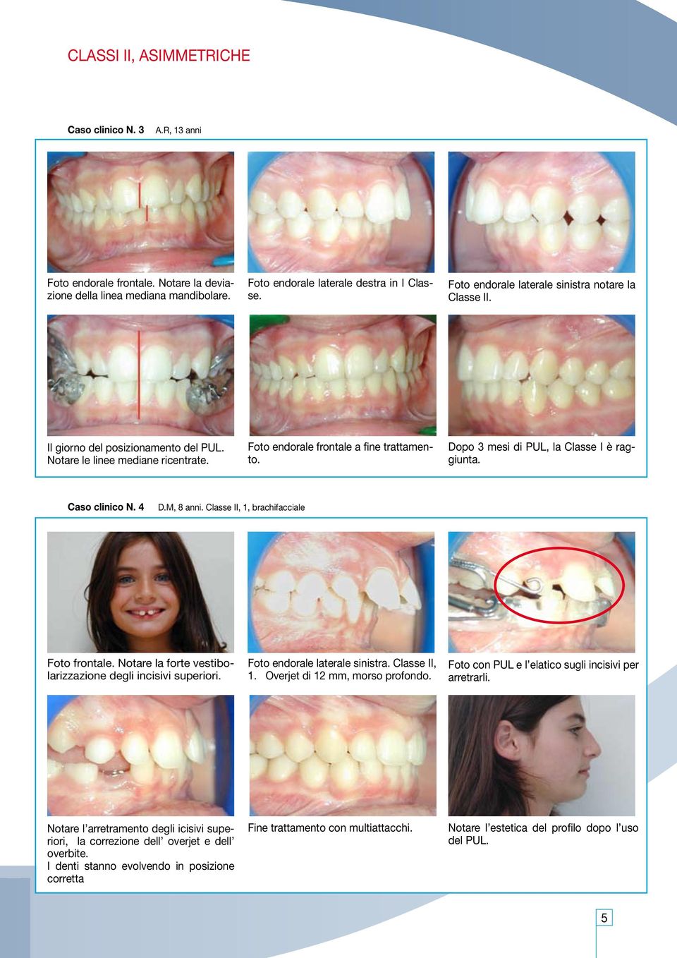 Dopo 3 mesi di PUL, la Classe I è raggiunta. Caso clinico N. 4 D.M, 8 anni. Classe II, 1, brachifacciale Foto frontale. Notare la forte vestibolarizzazione degli incisivi superiori.