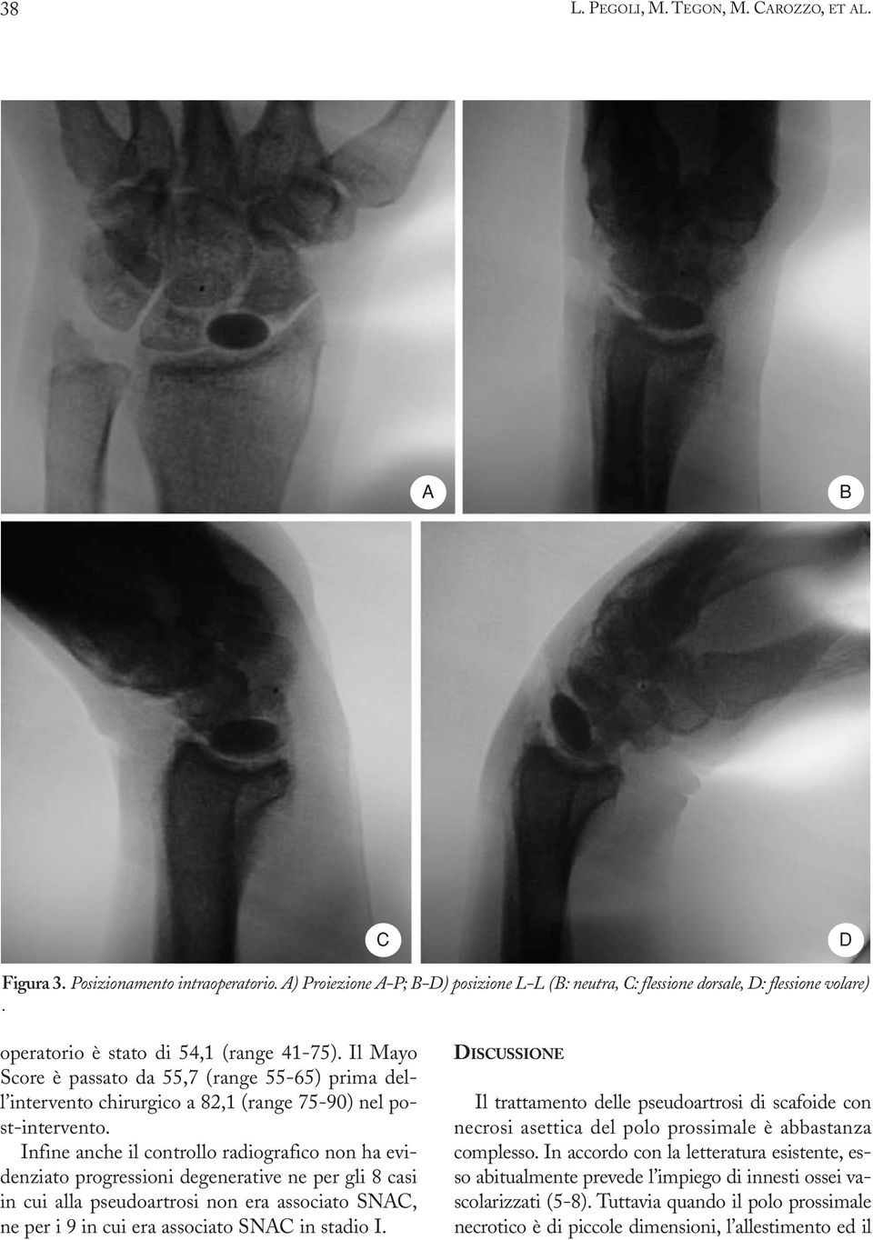 Infine anche il controllo radiografico non ha evidenziato progressioni degenerative ne per gli 8 casi in cui alla pseudoartrosi non era associato SNAC, ne per i 9 in cui era associato SNAC in stadio