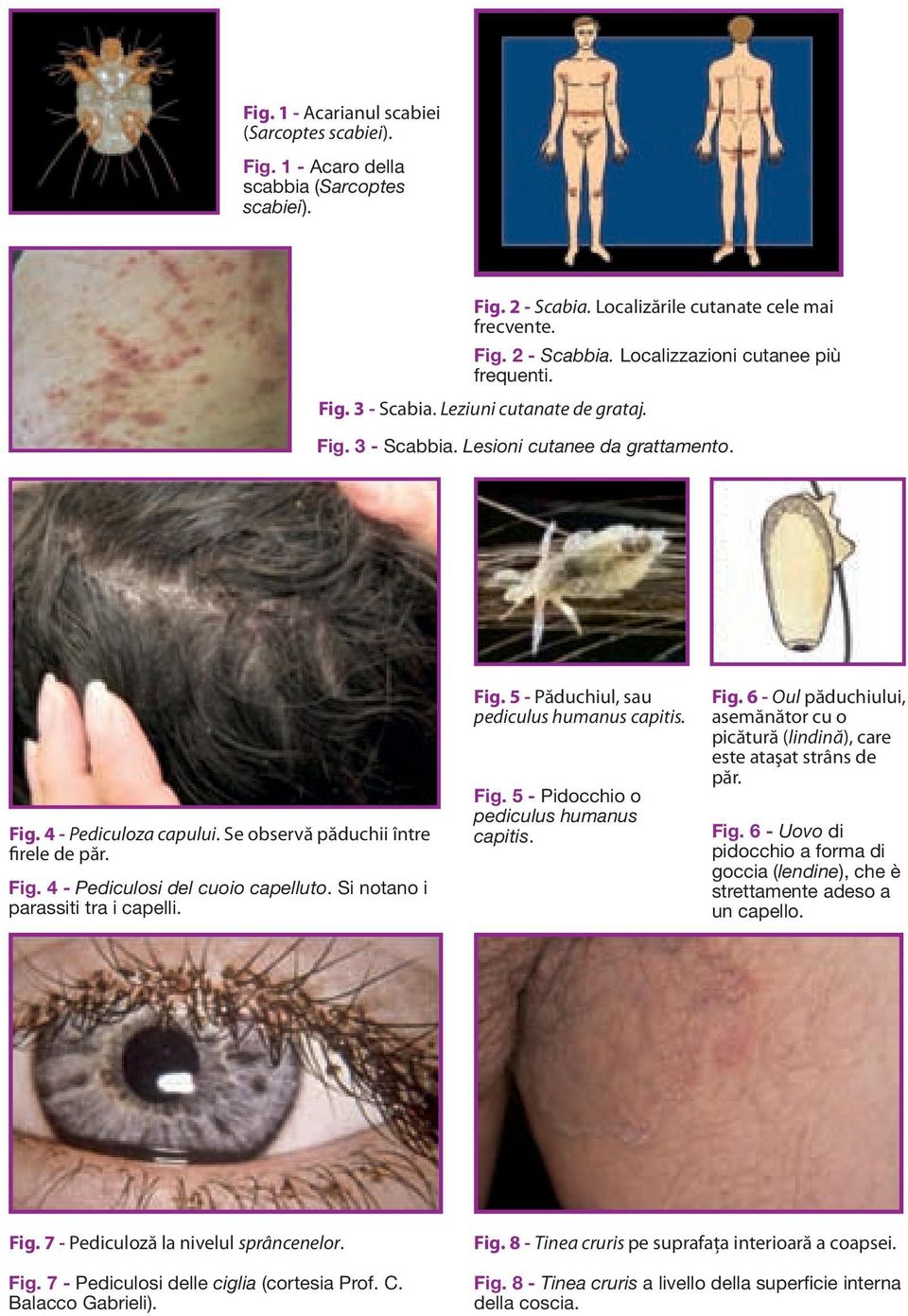 Se observă păduchii între firele de păr. Fig. 4 - Pediculosi del cuoio capelluto. Si notano i parassiti tra i capelli. Fig. 5 - Păduchiul, sau pediculus humanus capitis. Fig. 5 - Pidocchio o pediculus humanus capitis.