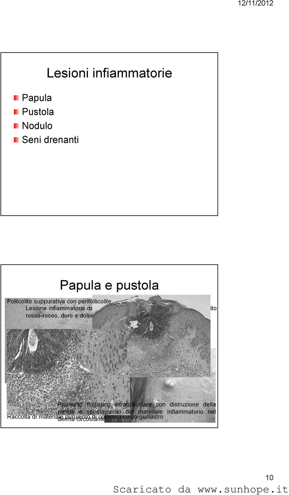 rosso-roseo, duro e dolente Processo flogistico intrafollicolare con distruzione della parete e