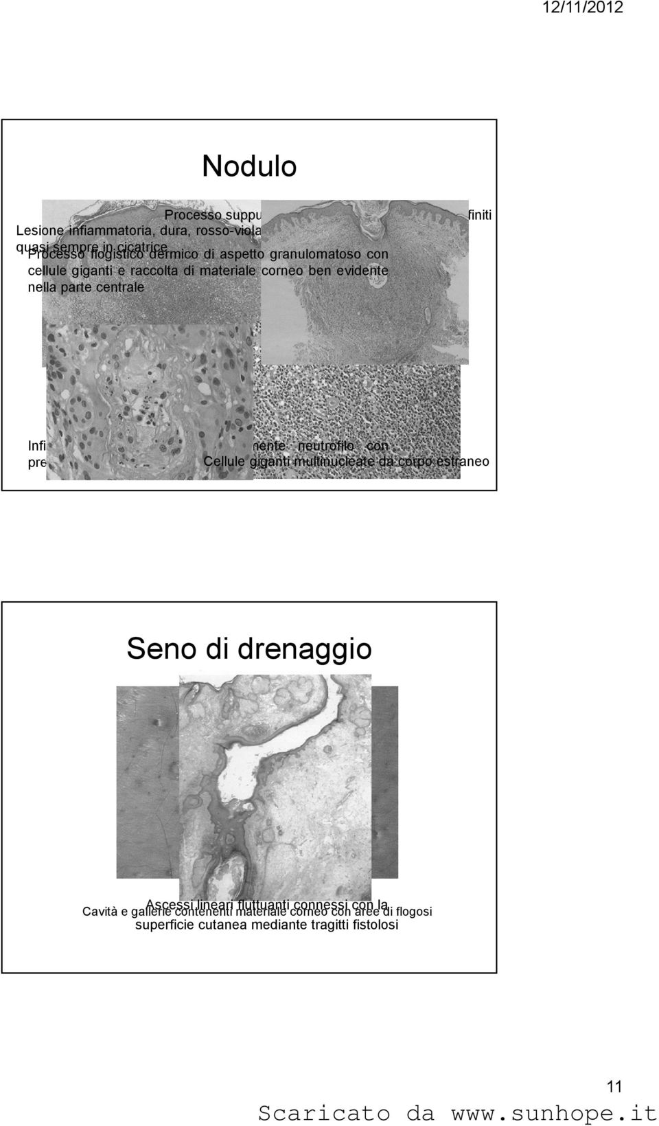 nella parte centrale Infiltrato infiammatorio prevalentemente neutrofilo con Cellule giganti multinucleate da corpo estraneo presenza di lamelle