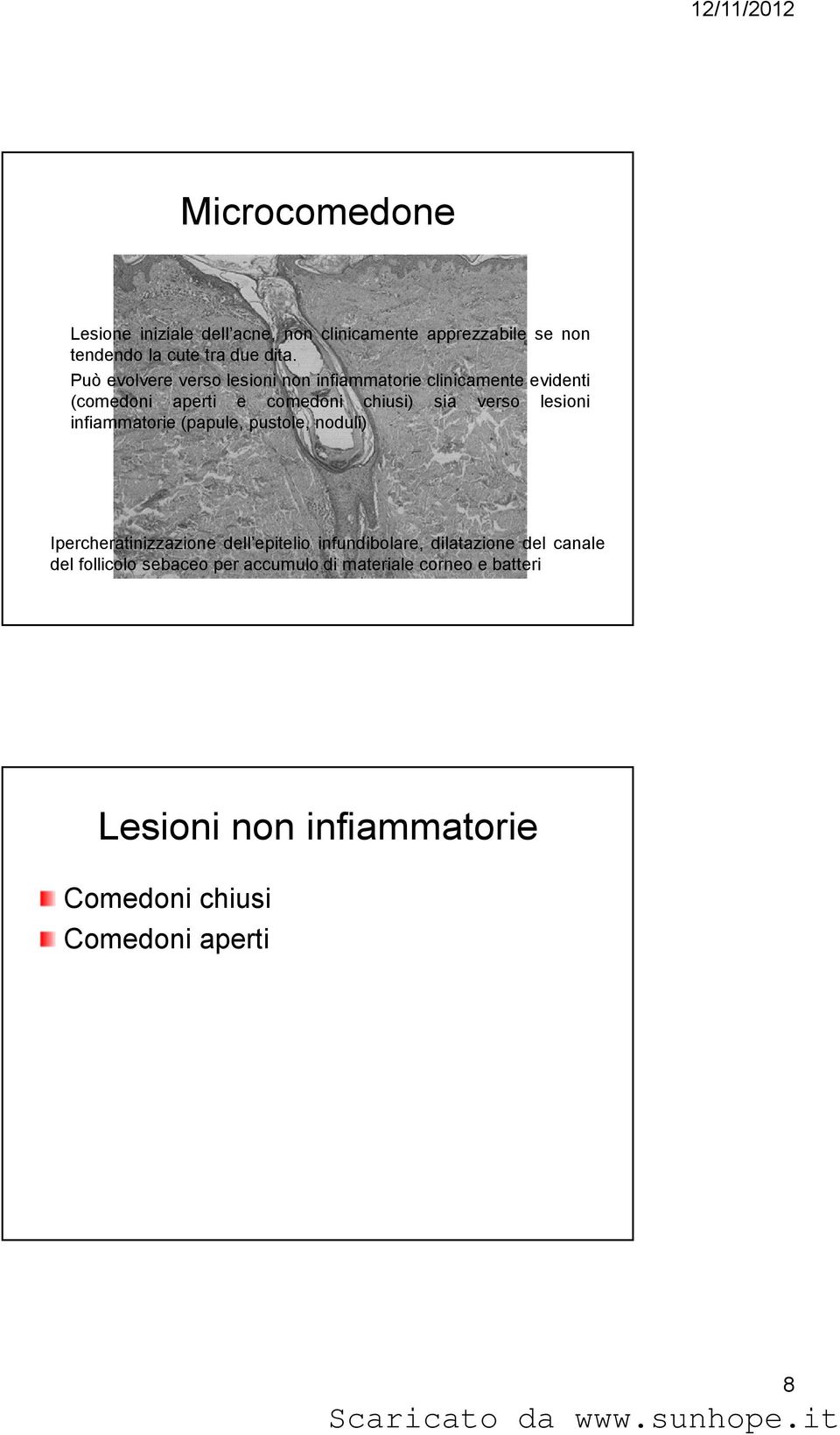 lesioni infiammatorie (papule, pustole, noduli) Ipercheratinizzazione dell epitelio infundibolare, dilatazione del