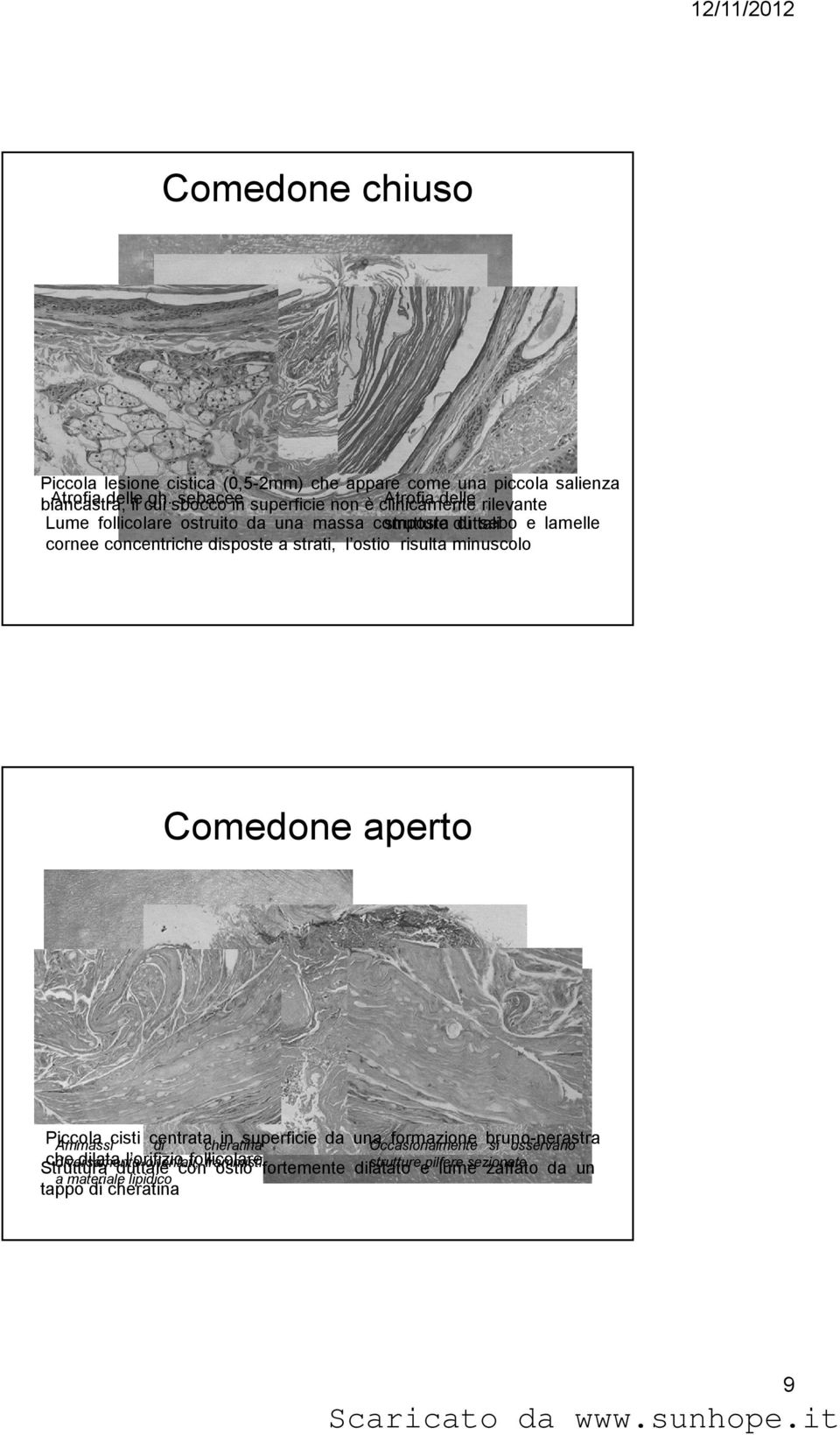 duttali cornee concentriche disposte a strati, l ostio risulta minuscolo Comedone aperto Piccola in superficie da una formazione bruno-nerastra Ammassicisti centrata di