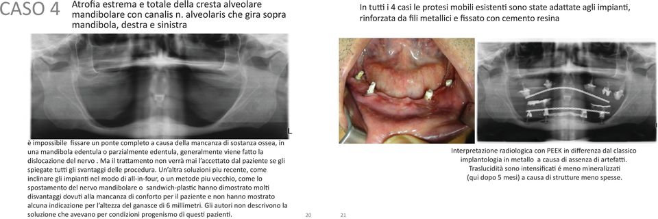 impossibile fissare un ponte completo a causa della mancanza di sostanza ossea, in una mandibola edentula o parzialmente edentula, generalmente viene fatto la dislocazione del nervo.