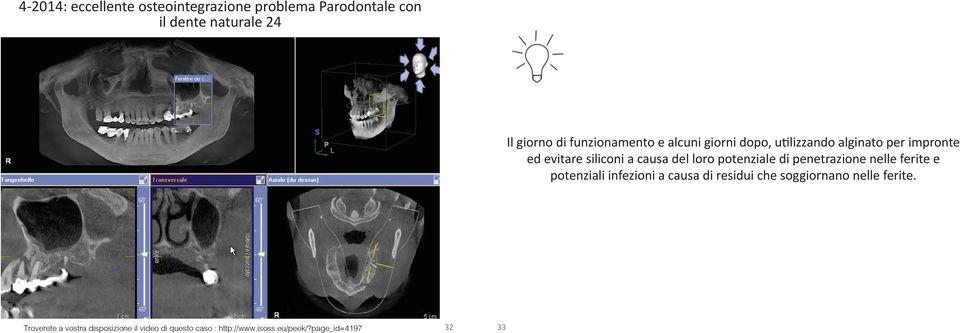 loro potenziale di penetrazione nelle ferite e potenziali infezioni a causa di residui che soggiornano