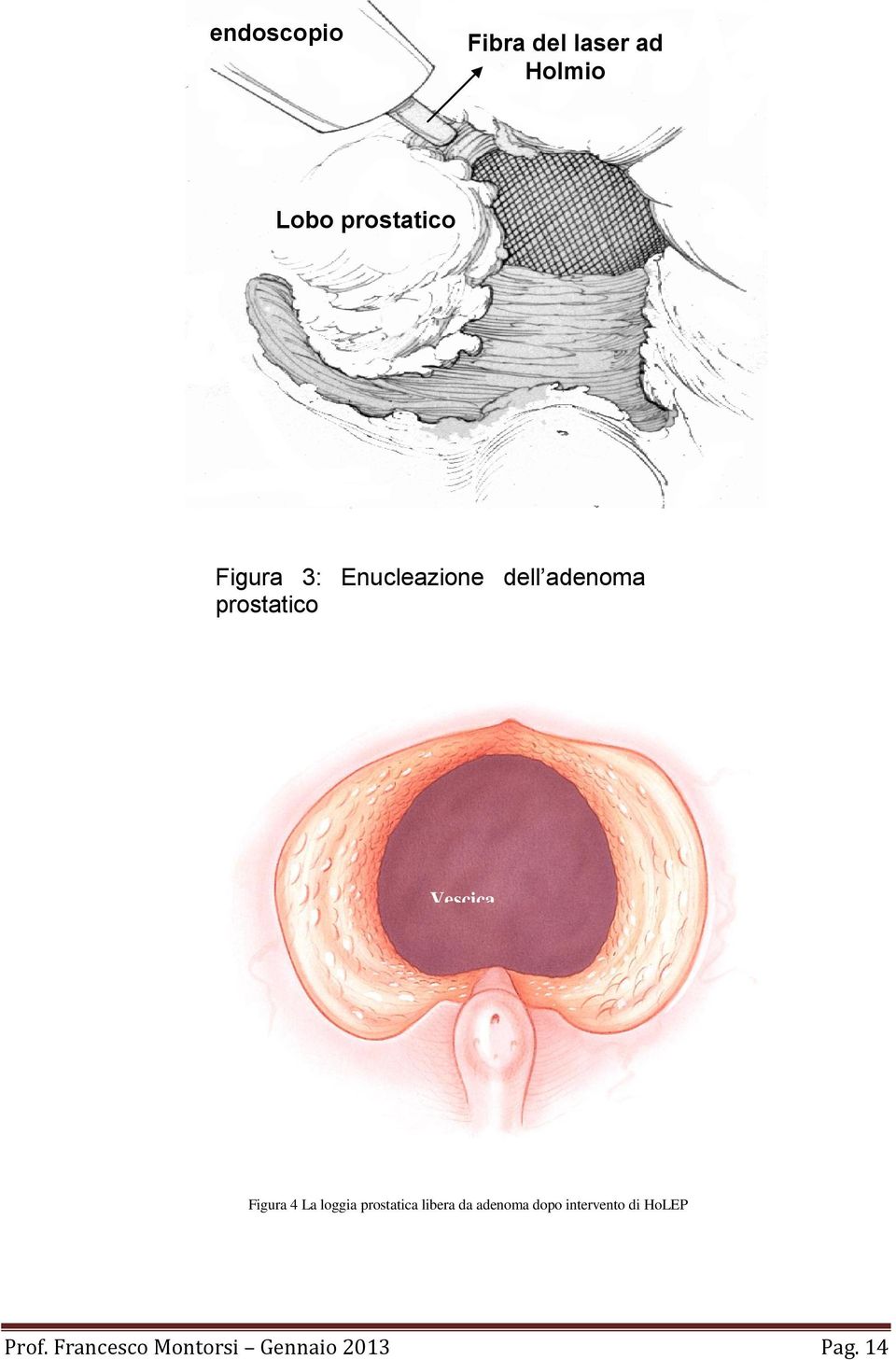 Figura 4 La loggia prostatica libera da adenoma dopo