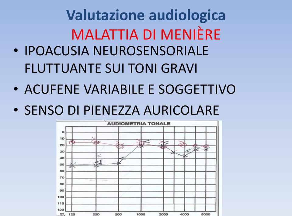 FLUTTUANTE SUI TONI GRAVI ACUFENE