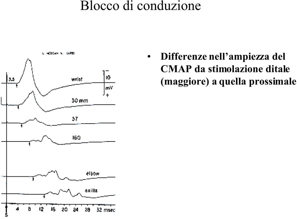 del CMAP da stimolazione