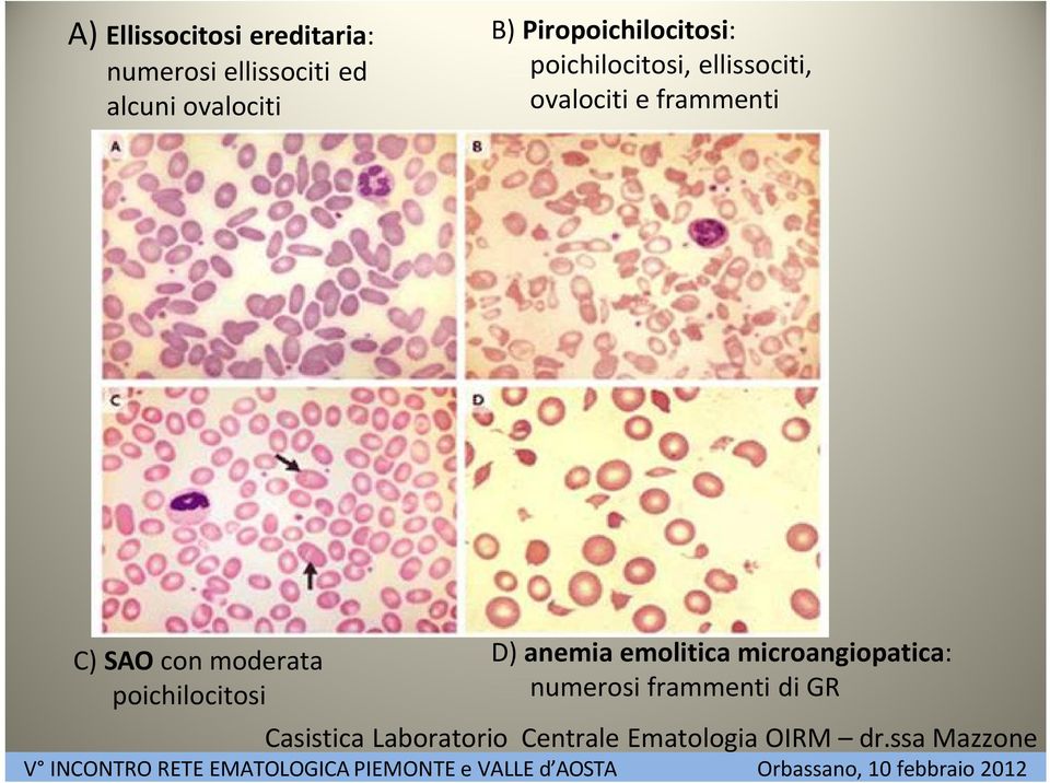 SAO con moderata poichilocitosi D) anemia emolitica microangiopatica:
