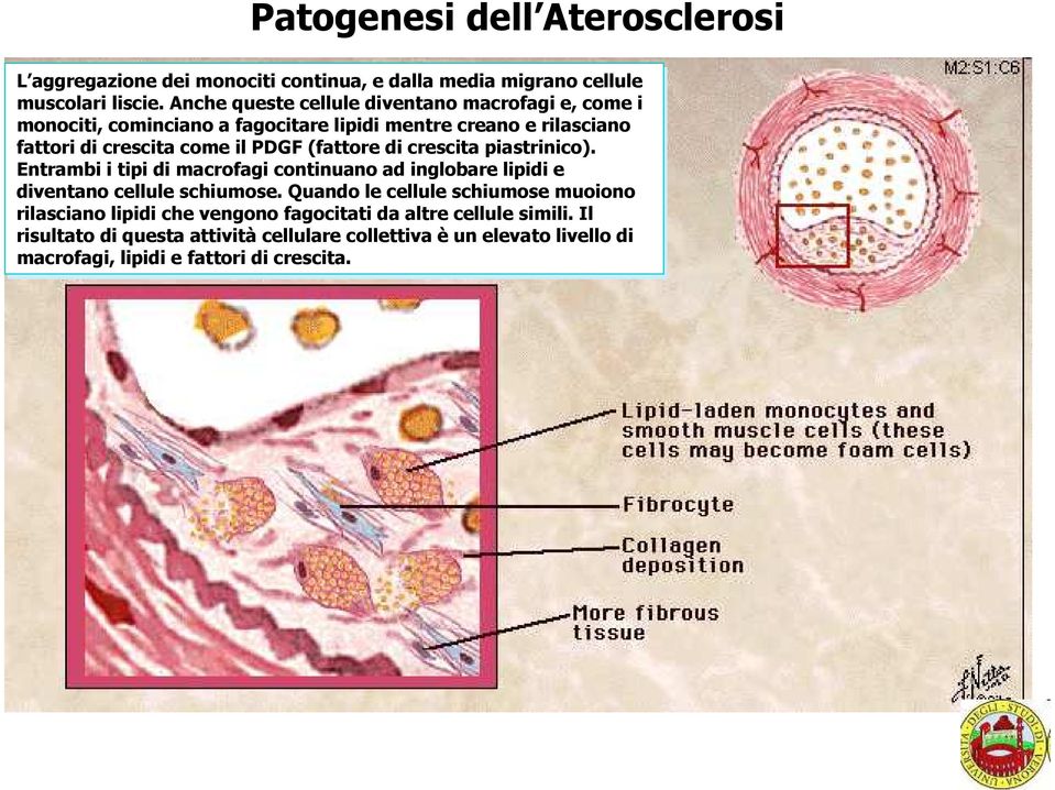 (fattore di crescita piastrinico). Entrambi i tipi di macrofagi continuano ad inglobare lipidi e diventano cellule schiumose.
